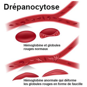 Consultation / Traitement Anti-drépanocytose